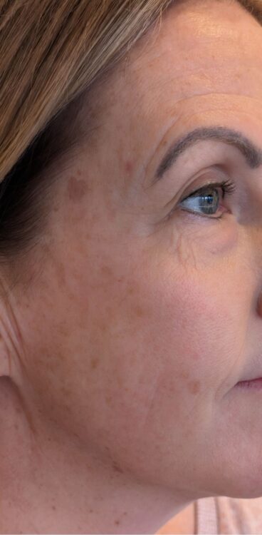 March 2026 Lotus Beauty Hydro Facial for Pigmentation Results after
