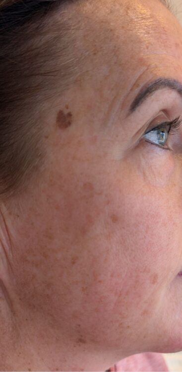 March 2026 Lotus Beauty Hydro Facial for Pigmentation Results before