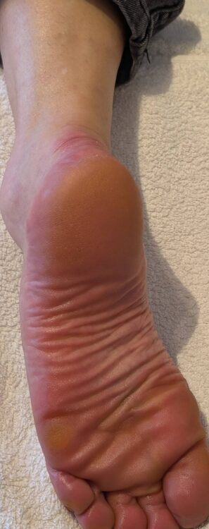 March 2026 Lotus Beauty Lounge Microdermabrasion Pedicure for Dry Cracked Skin Feet Rejuvenation Before and After