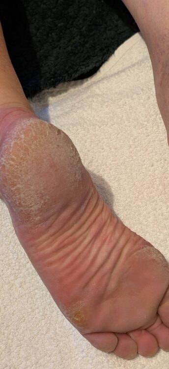 March 2026 Lotus Beauty Lounge Microdermabrasion Pedicure for Dry Cracked Skin Feet Rejuvenation Before and After
