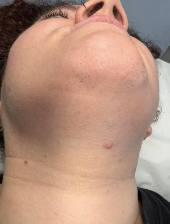 March-2026-Neo-Rebecca-IPL-treatment-for-unwanted-Hair-Chin-results-after