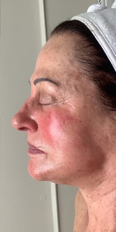 March 2026 Radiance Aesthetics Portsmouth Collagen Lift Mature Skin Rejuvenation facial after