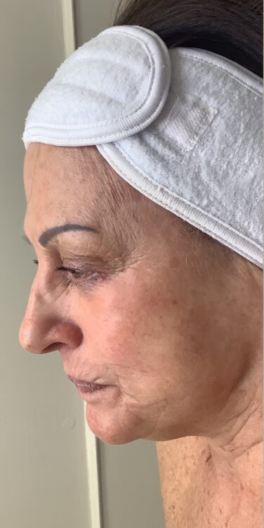 March 2026 Radiance Aesthetics Portsmouth Collagen Lift Mature Skin Rejuvenation facial before