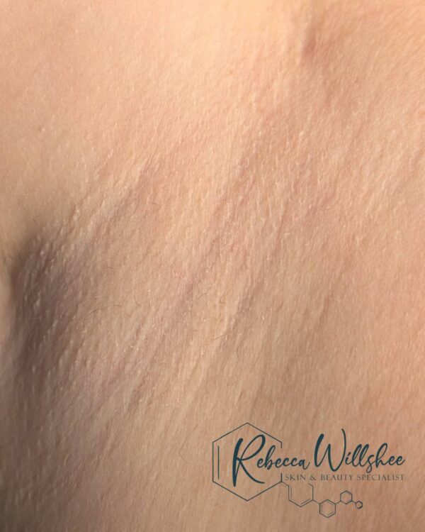 March 2026 Rebecca Willshee unwanted underarm hair treatment IPL after