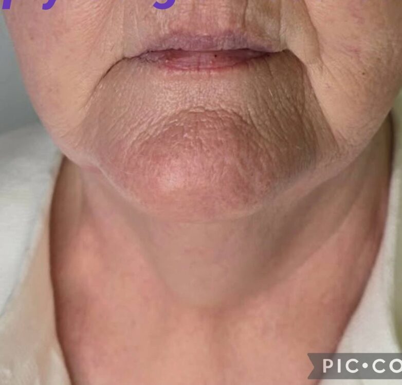 March 2026 Simply Gorgis Aesthetics Ageing Sagging Skin Non Surgical Treatment Collagen Lift Radio Frequency Results after