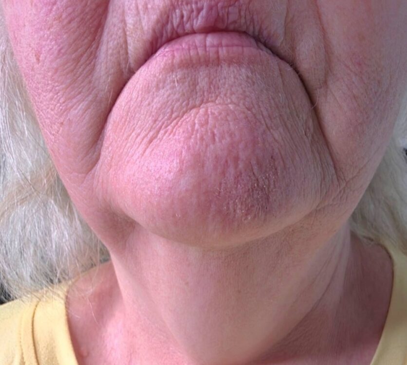 March 2026 Simply Gorgis Aesthetics Ageing Sagging Skin Non Surgical Treatment Collagen Lift Radio Frequency Results Before