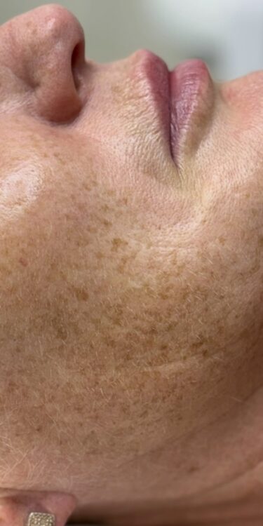 March-2026-Skin-Studio-Ormskirk-IPL-Hydro-Combination-for-Pigmented-Ageing-Skin-Non-Surgical-Treatment-Results-Before