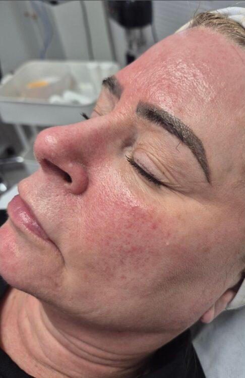 March 2026 Studio 333 Rosacea Treatment Intense Pulsed Light Photorejuvenation and Vascular facial results after