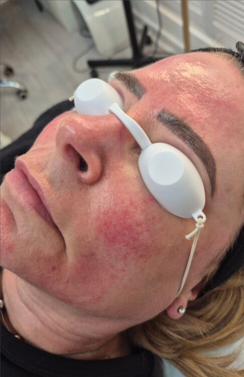 March 2026 Studio 333 Rosacea Treatment Intense Pulsed Light Photorejuvenation and Vascular facial results before