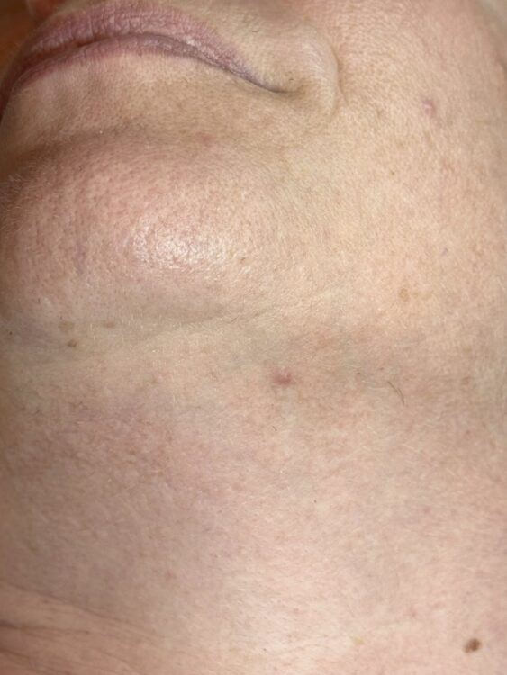 March 2026 TLV Beauty Unwanted Facial Hair Chin Intense Pulsed Light Therapy Results after