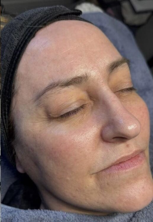March 2026 The Luminous Clinic Microdermabrasion Skin Refresh Ageing Skin Results After