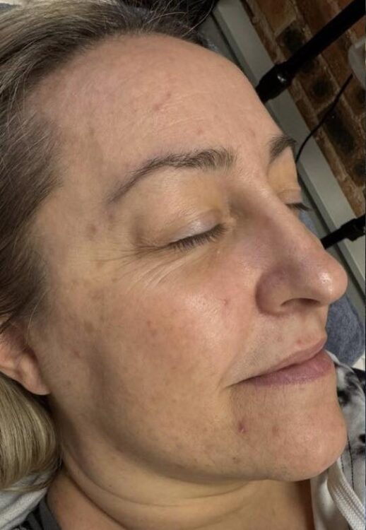 March 2026 The Luminous Clinic Microdermabrasion Skin Refresh Ageing Skin Results Before