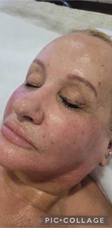 March 2026 Uptown HBA Laser Clinic Collagen Lift Ageing Skin Rejuvenation Facial Non-Surgical Rejuvenation Gina Boyd After