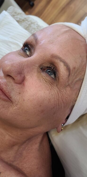 March 2026 Uptown HBA Laser Clinic Collagen Lift Ageing Skin Rejuvenation Facial Non-Surgical Rejuvenation Gina Boyd Before