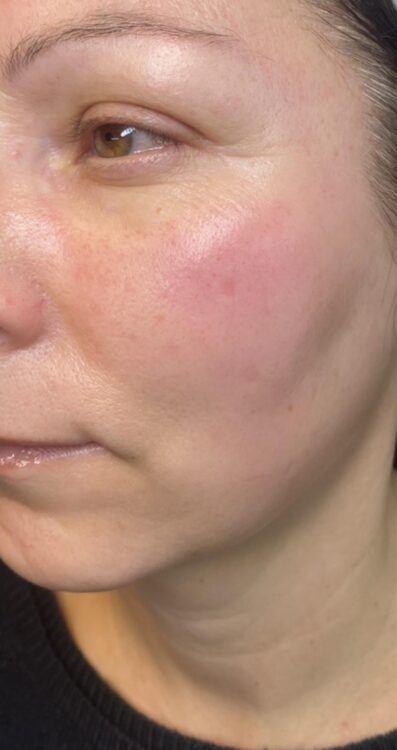 March 2026 the Skin Refinery Collagen Lift ULTIMATE Dull Ageing Lacklustre skin treatment radio frequency results after