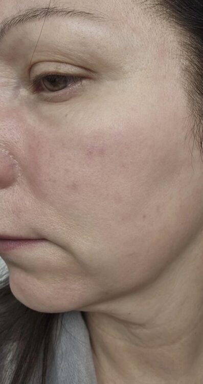 March 2026 the Skin Refinery Collagen Lift ULTIMATE Dull Ageing Lacklustre skin treatment radio frequency results before