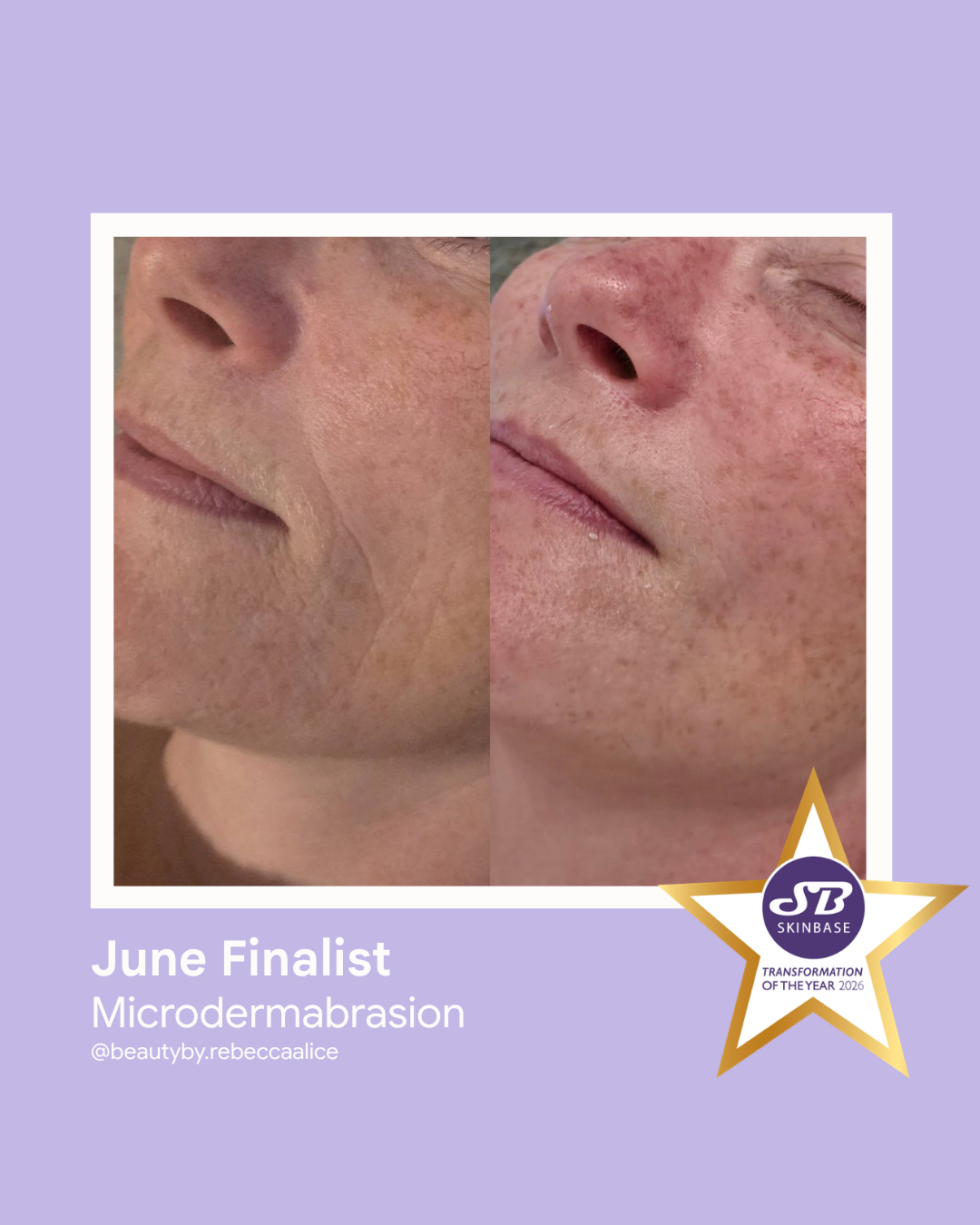 FINALIST June 2026 Beauty by Rebecca Alice Microdermabrasion