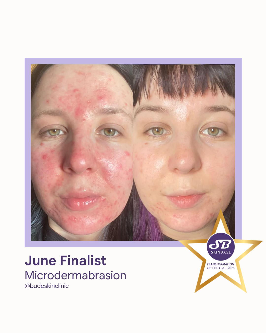FINALIST June 2026 Bude Skin Clinic Microdermabrasion
