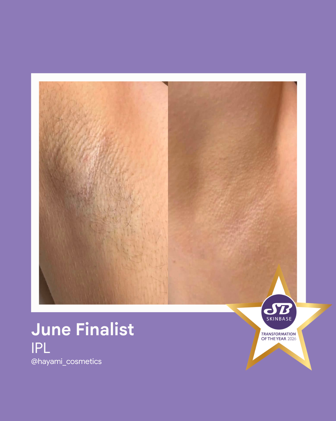 FINALIST June 2026 Hayami Cosmetics IPL