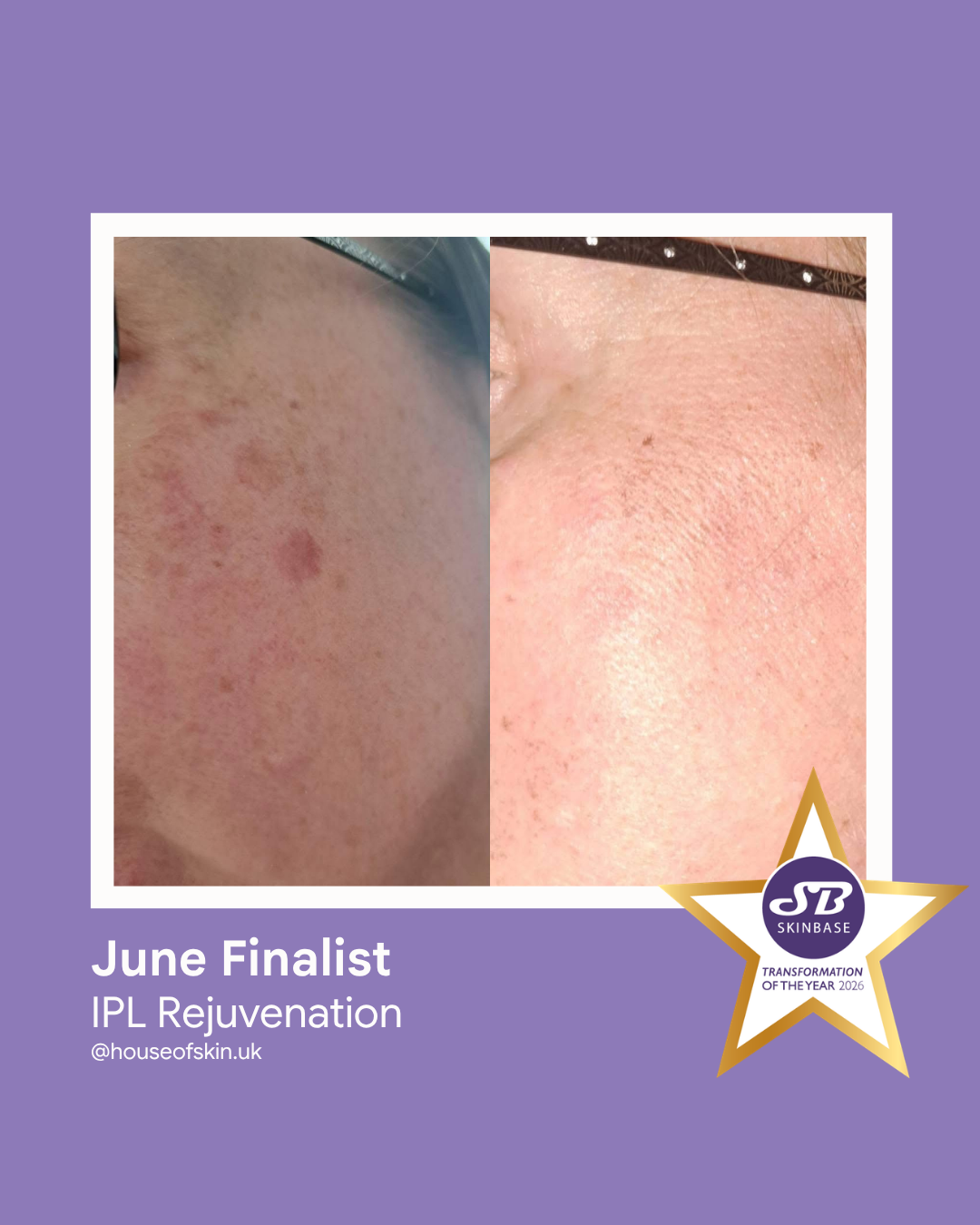 FINALIST June 2026 House of Skin IPL Rejuvenation
