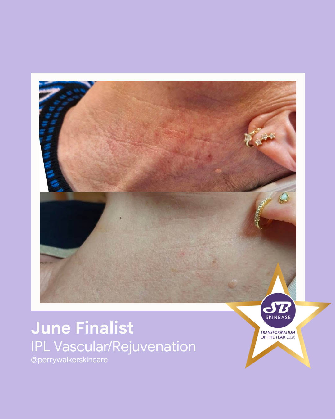 FINALIST June 2026 Perry Walker Skincare Specialist IPL