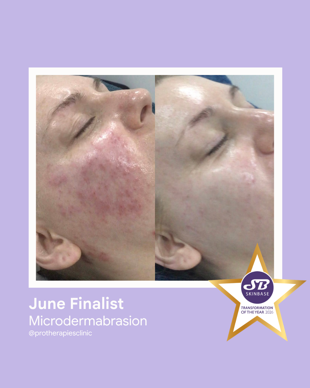 FINALIST June 2026 ProTherapies Microdermabrasion