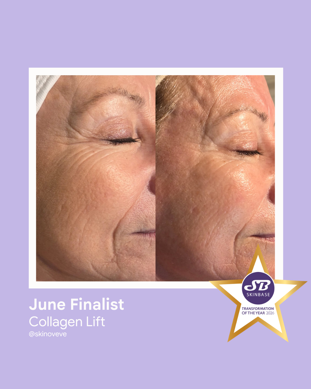 FINALIST June 2026 Skinoveve Collagen Lift