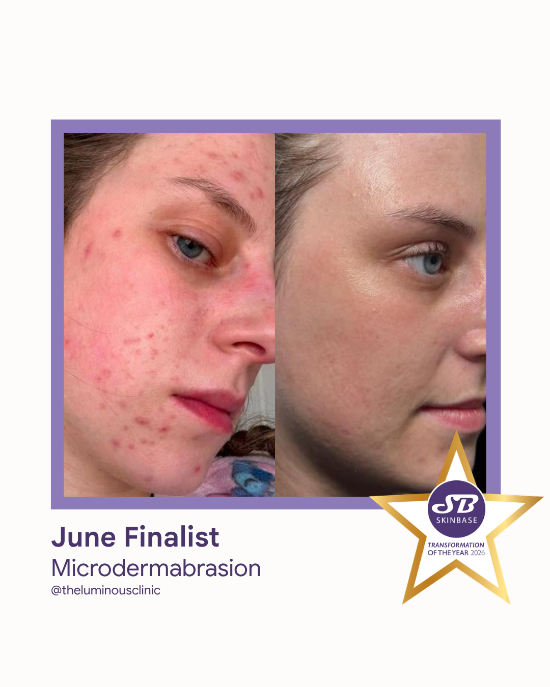 FINALIST June 2026 The Luminous Clinic Cheshire Microdermabrasion
