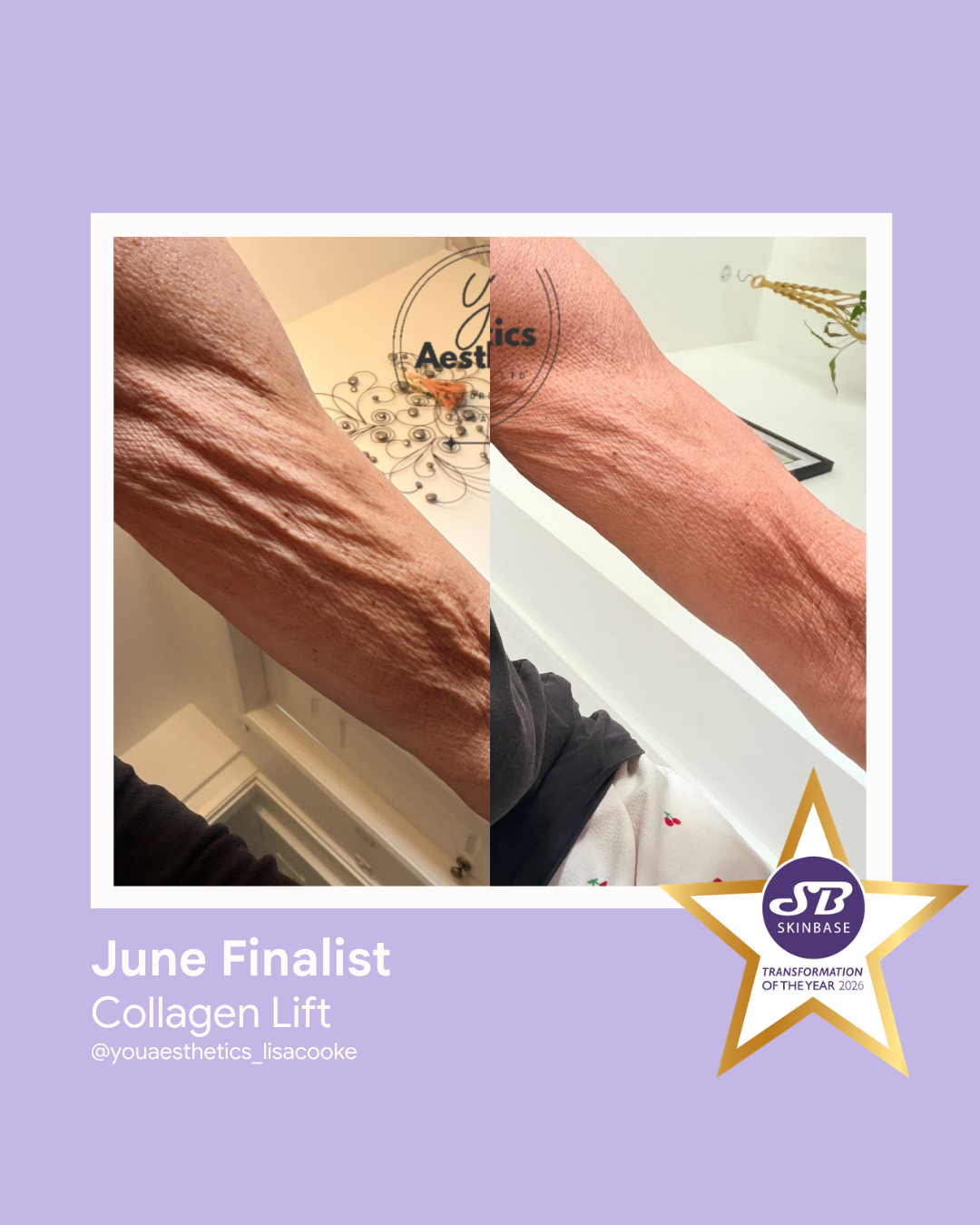FINALIST June 2026 You Aesthetics Staffordshire Ltd Collagen Lift